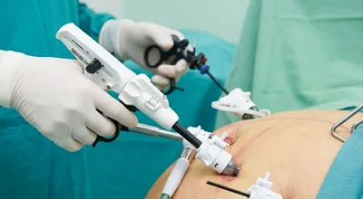 Laparoscopic Sleeve Gastrectomy